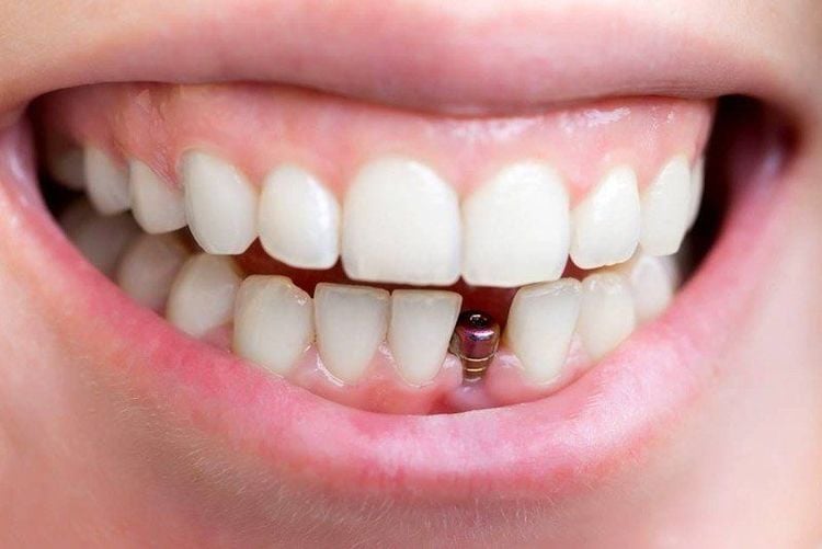 
Sau cấy ghép Implant, người bệnh cần thời gian phục hồi
