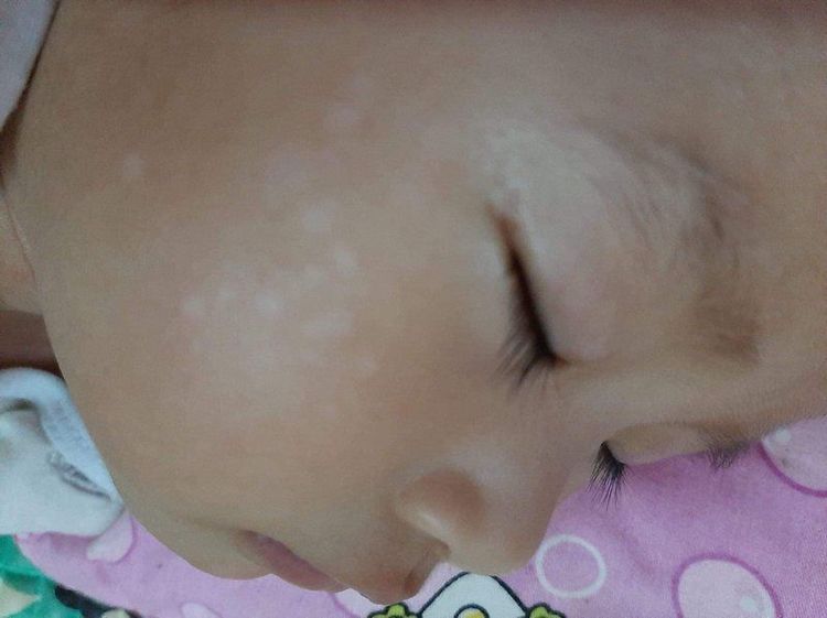 How to treat vitiligo in the face for a 10-month-old baby?