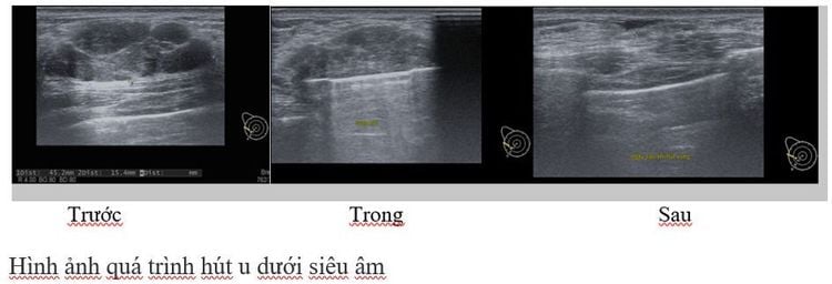 Điều trị hút bỏ u vú lành tính bằng kỹ thuật sinh thiết có hỗ trợ của thiết bị hút chân không dưới hướng dẫn của siêu âm