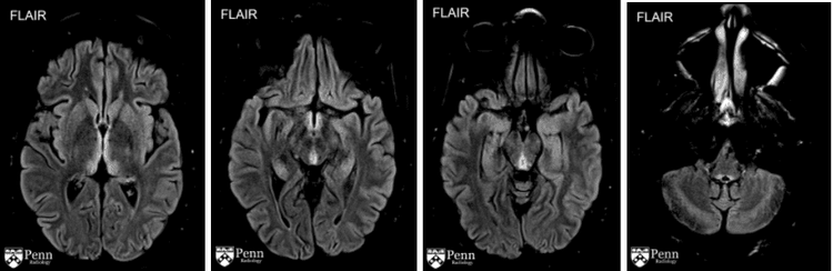 
Hình MRI não ở bệnh nhân bị bệnh não Wernicke: tăng tín hiệu trên chuỗi xung T2 FLAIR ở nhân lưng trong của đồi thị hai bên, thể vú, chất xám quanh cống não và dọc theo não thất IV/tủy lưng (dorsal medull)
