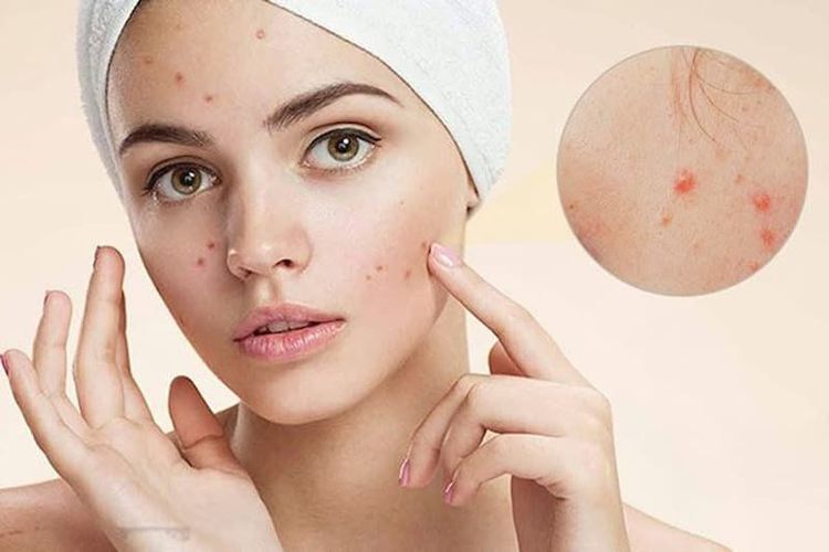 
Mụn trứng cá viêm nhẹ đến trung bình thường được điều trị bằng retinoids kết hợp với thuốc kháng sinh tại chỗ hoặc benzoyl peroxide
