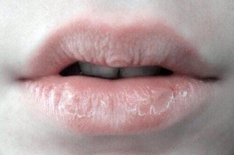 If you experience itchy lips for several weeks, accompanied by cracked lips and bleeding, you should see a doctor immediately.