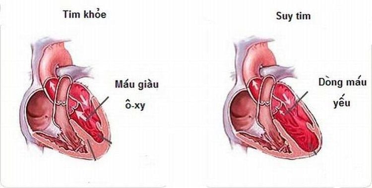 
Hình ảnh tim bình thường và suy tim
