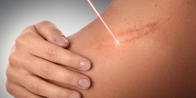 
Liệu pháp laser là phương pháp thường được sử dụng để cải thiện sẹo bỏng
