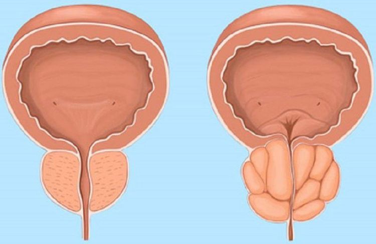 
Thuốc Rapaflo dùng để điều trị các triệu chứng của phì đại tuyến tiền liệt
