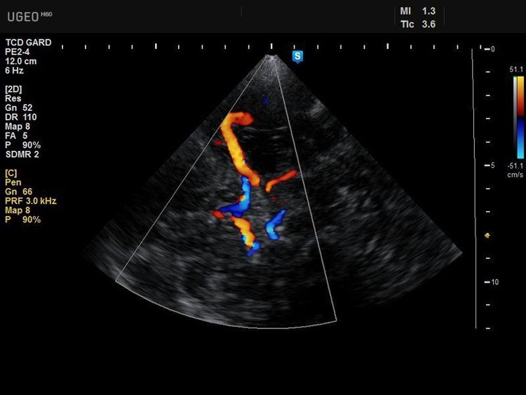 
Ưu điểm đầu dò xung của máy siêu âm doppler xuyên sọ là xác định được vị trí dòng chảy.
