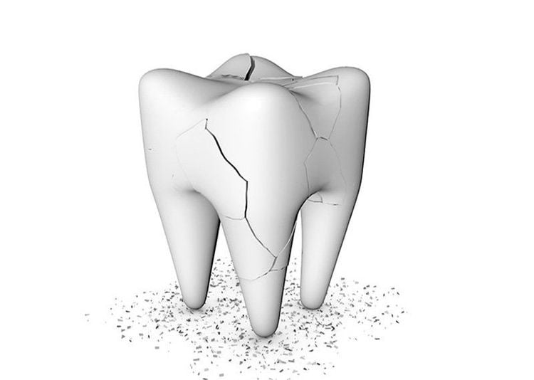 
Nếu bạn bị mẻ hoặc nứt răng, vi khuẩn có thể xâm nhập, dẫn đến viêm và nhiễm trùng
