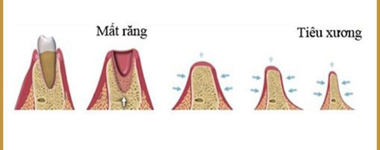 
Tiêu quanh răng gồm viêm quanh răng và hư quanh răng
