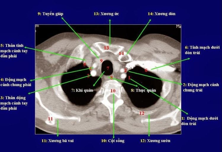 
Chụp cắt lớp vi tính lồng ngực sẽ giúp chẩn đoán sớm nhiễm nấm Aspergillus ở phổi.
