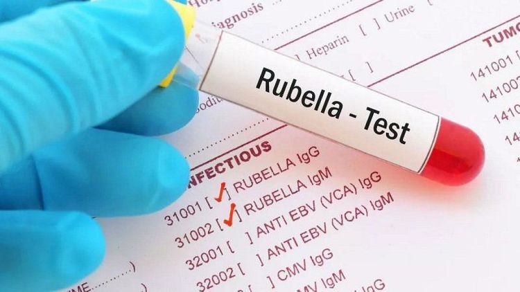 
Bác sĩ có thể chẩn đoán bệnh rubella thông qua xét nghiệm máu
