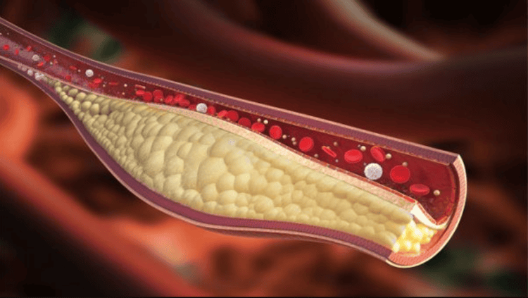 
Đặt stent động mạch thận để mở rộng lòng động mạch thận
