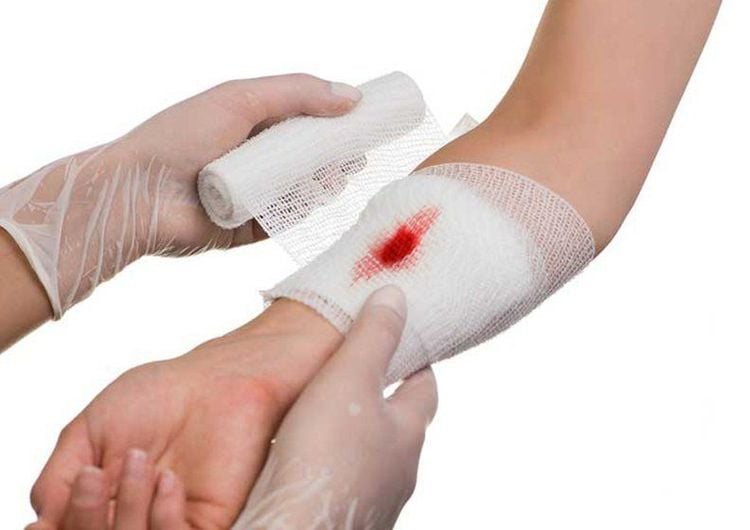 Vết thương hở bị nhiễm trùng thường chảy dịch, có mùi khó chịu