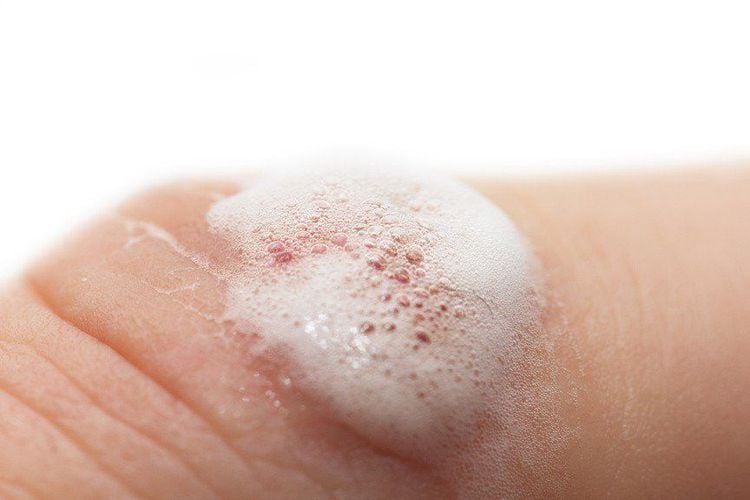 Using hydrogen peroxide to clean wounds causes a stinging sensation