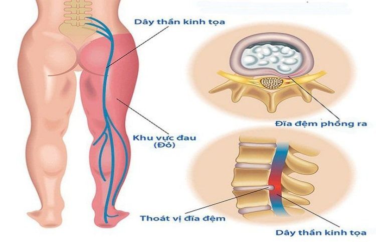 Thoát vị đĩa đệm là một trong các nguyên nhân gây đau thần kinh tọa