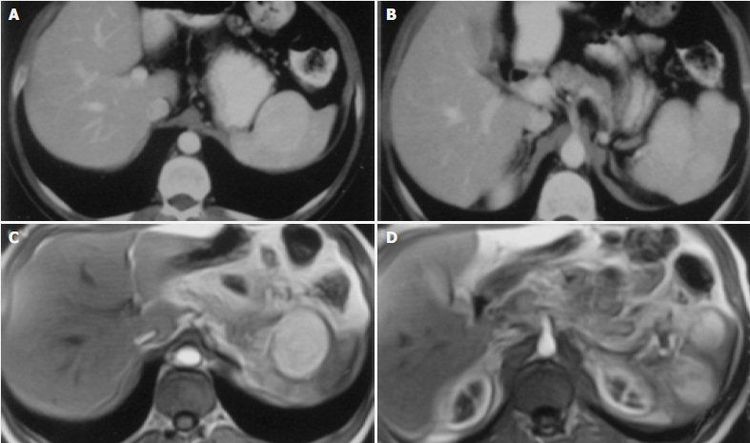 
Bác sĩ có thể sử dụng phương pháp chụp MRI chẩn đoán lách to
