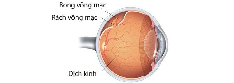 
Một số tổn thương võng mạc trong đó có bong võng mạc
