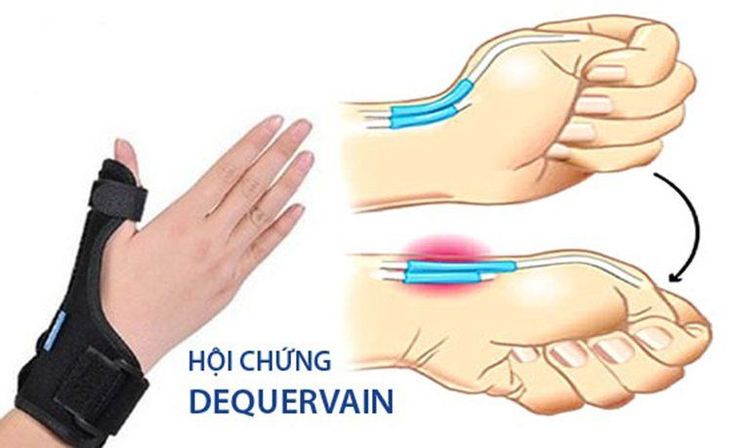 
Viêm bao gân là một trong những tồn thương mô mềm hay gặp
