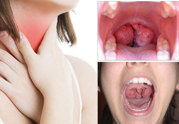 
Tonsillitis causes the patient to feel a sore throat
