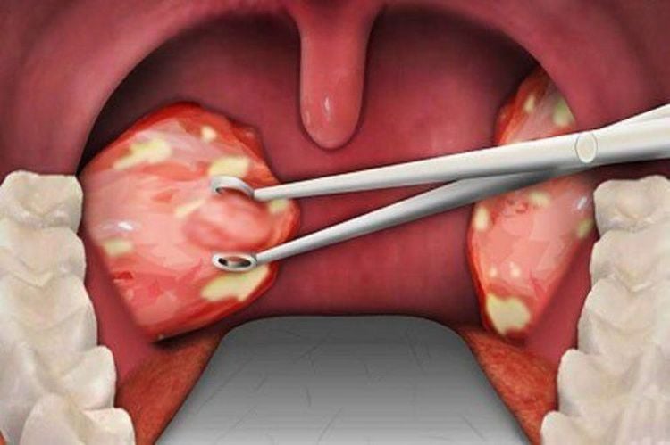 
Pus from tonsillitis is used to make antibiograms
