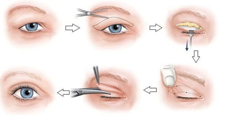 
Mắt 1 mí nên cắt mí hay nhấn mí là thắc mắc của nhiều chị em
