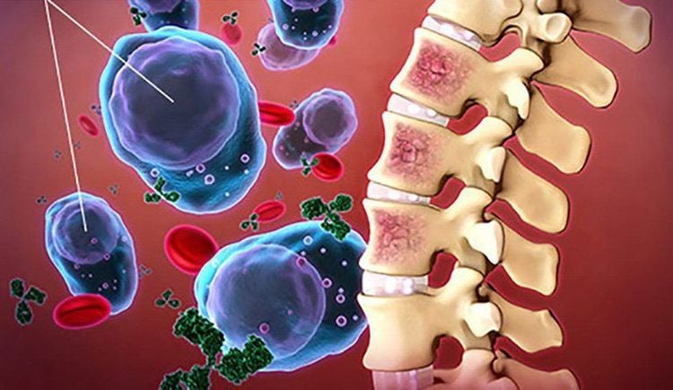 
Bệnh viêm xương tủy xương do một loại vi khuẩn được gọi là Staphylococcus aureus gây ra
