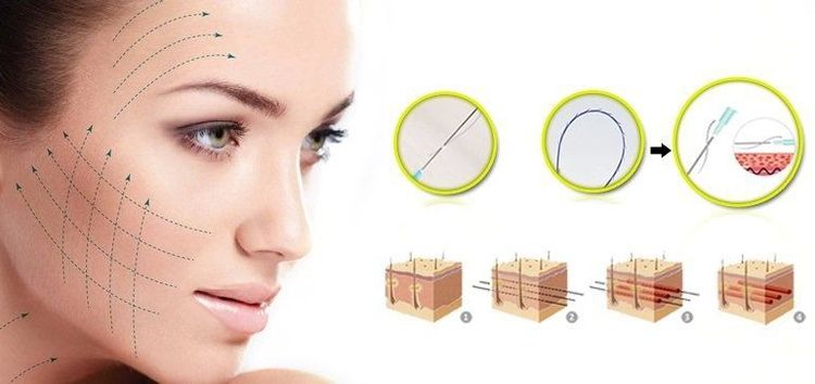 
Căng chỉ collagen có an toàn không là thắc mắc của nhiều chị em
