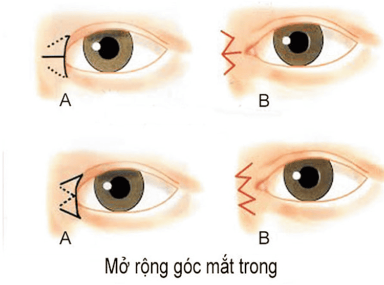 
Mở rộng góc mắt giúp chị em có được đôi mắt tràn đầy sức sống
