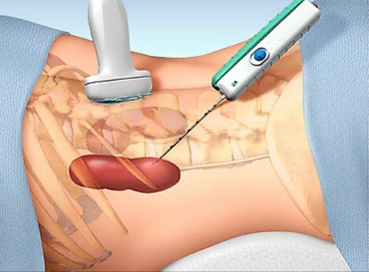 
Sinh thiết thận qua da giúp bác sĩ chẩn đoán và đưa ra phác đồ điều trị bệnh phù hợp
