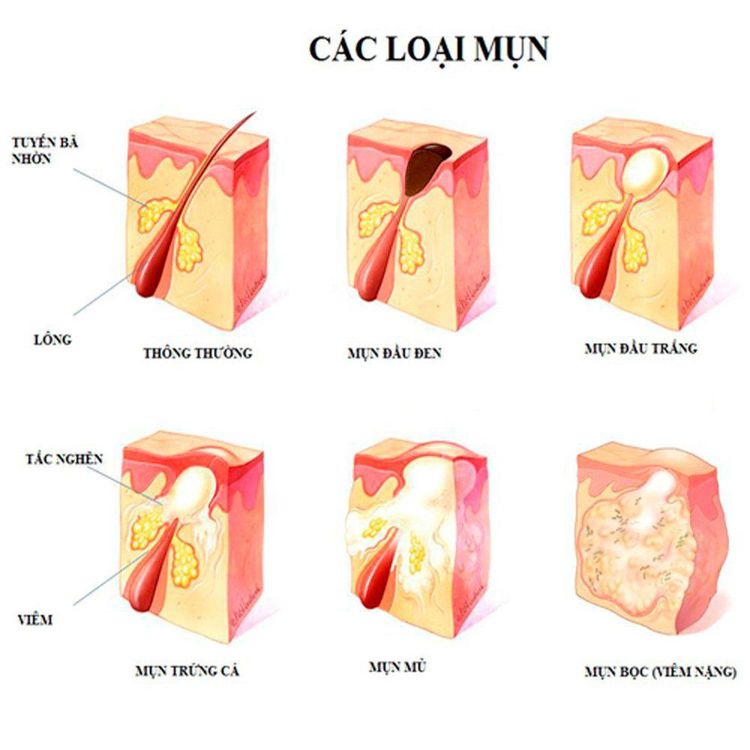 
Bạn có thể mọc nhiều loại mụn lưng, như mụn đầu trắng, mụn đầu đen, mụn nhọt, mụn mủ, mụn trứng cá...
