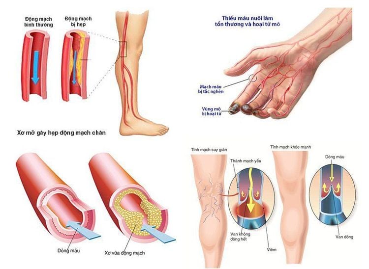 
Phẫu thuật cắt mạch máu ngày càng tăng và đem lại hiệu quả điều trị cao
