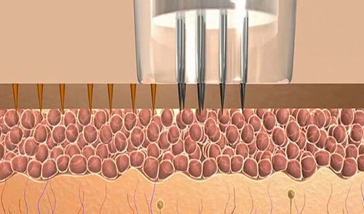 
Lăn kim có trị được rạn da không là thắc mắc của nhiều chị em
