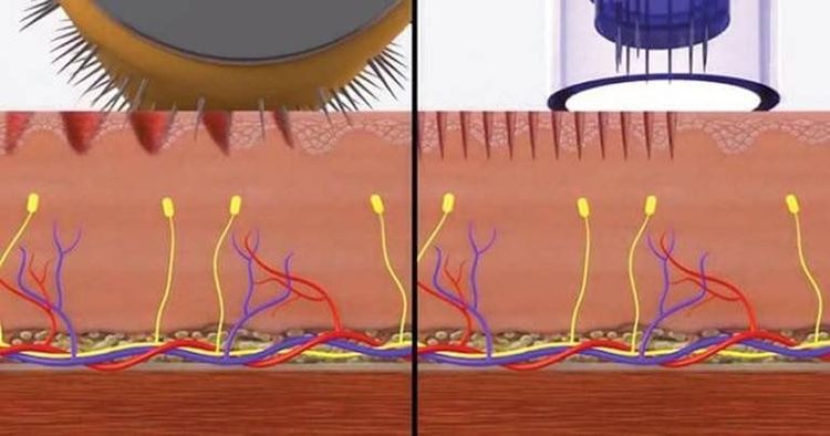 
Lăn kim trị rạn da do khả năng tái tạo làn da bị rạn nứt của công nghệ này
