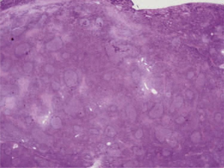 
U lympho vùng cận biên tế bào B của mô lympho liên kết với niêm mạc (MALT lymphoma)
