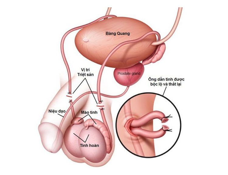 
                    Biện pháp tránh thai vĩnh viễn có thể áp dụng cho cả nam giới
                