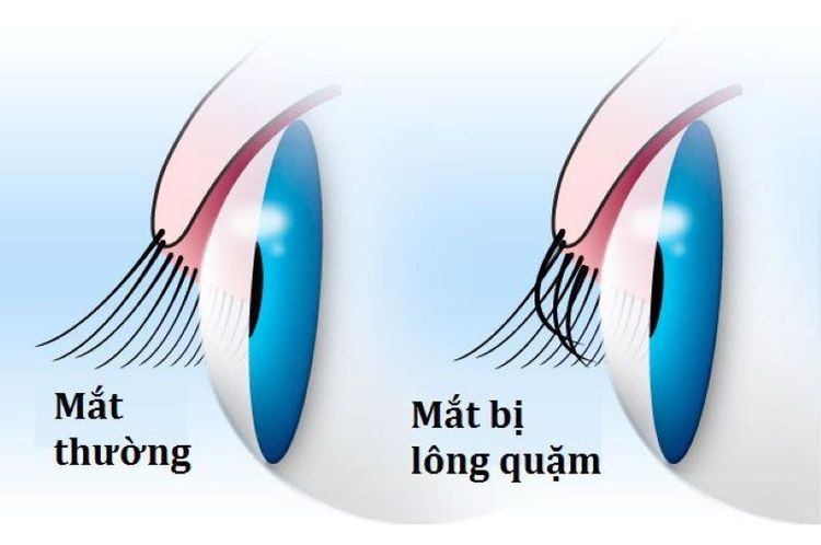 
Quặm mi mắt là tình trạng cuộn bờ mi vào trong nhãn cầu khiến lông mi và da cọ xát với phần giác mạc và kết mạc
