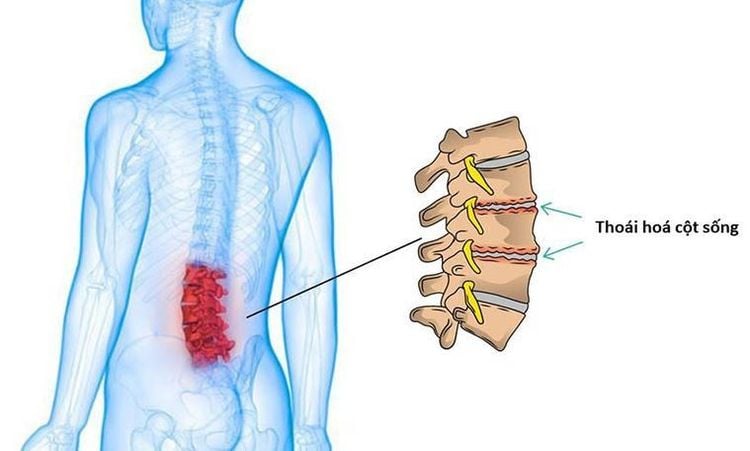 
Thoái hóa cột sống có thể là một trong các nguyên nhân gây đau cô vai gáy
