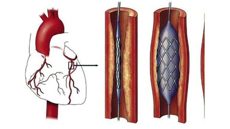 
Can thiệp mạch vành qua da giúp mở các mạch máu trong tim bị thu hẹp do mảng bám tích tụ
