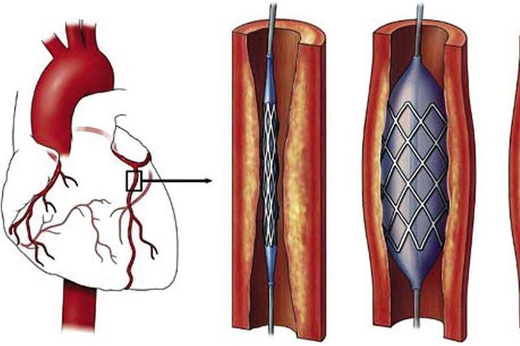 
Việc chăm sóc sau đặt stent mạch vành giúp người bệnh nhanh chóng hồi phục
