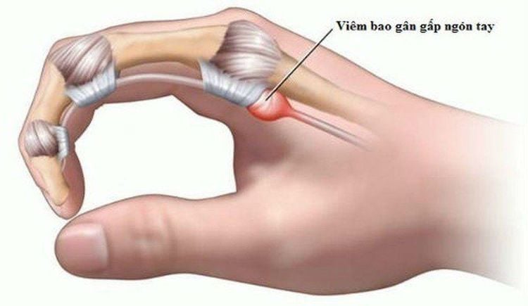 
Viêm bao gân gây đau nhức tay trái, phải
