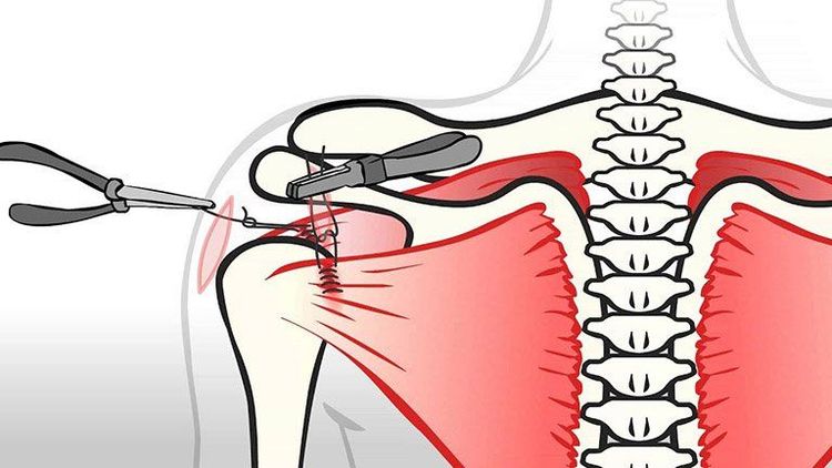 
Các trường hợp nghiêm trọng có thể được phẫu thuật rách xoay chỏm vai
