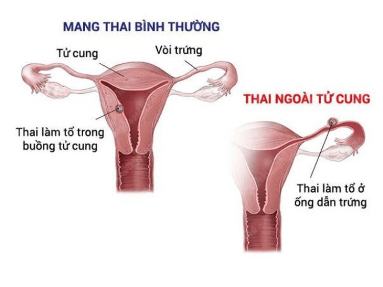 
Khí hư có máu có thể là dấu hiệu của mang thai ngoài tử cung
