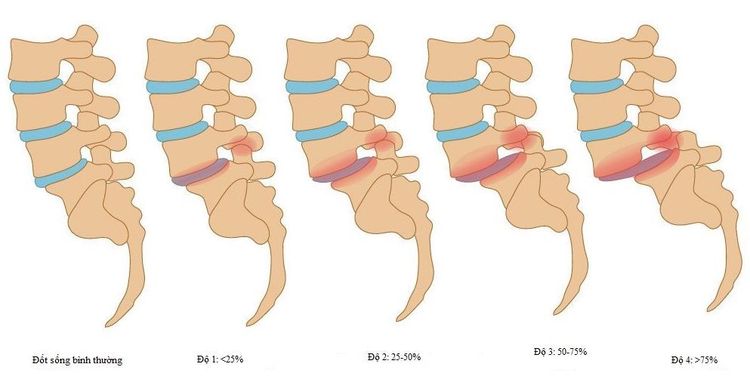 
Hình ảnh so sánh tỷ lệ trượt đốt sống lưng
