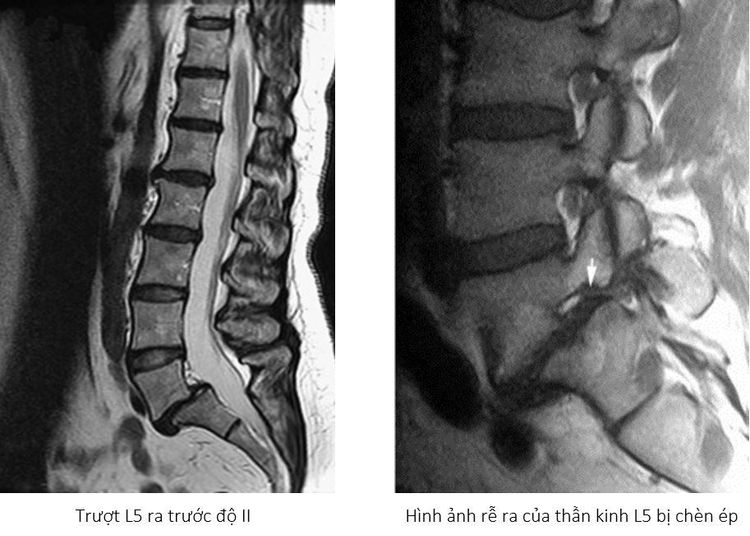 
Hình ảnh trượt đốt sống lưng trên kết quả MRI
