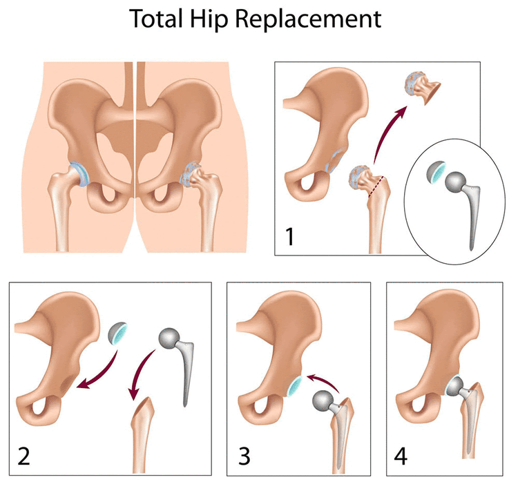 
Hình minh họa Các bước của phẫu thuật thay khớp háng
