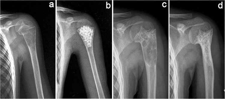 
Bác sĩ có thể chẩn đoán nang xương đơn độc thông qua hình ảnh Xquang của bệnh nhân
