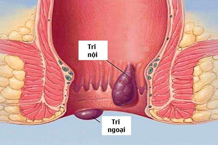 
Trĩ nội độ 1-2 và trĩ ngoại bị sa ra ngoài
