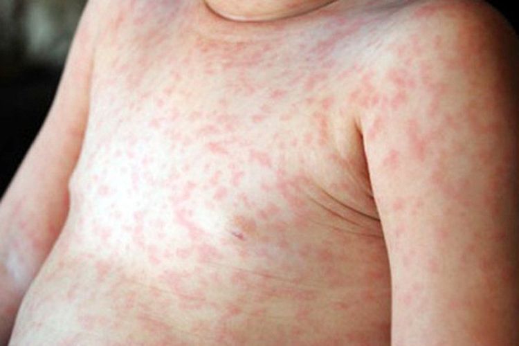 Trẻ nổi phát ban sau sốt virus có sao không?