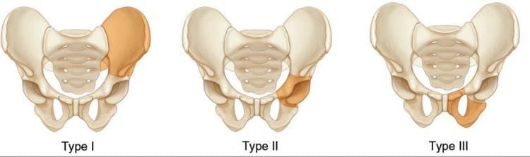 
Phân vùng phẫu thuật thay xương chậu
