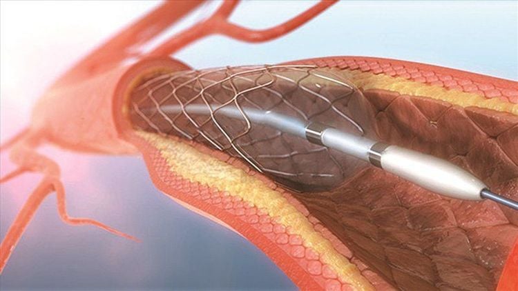 Nong mạch vành điều trị hẹp động mạch vành giúp cải thiện tình trạng đau thắt ngực