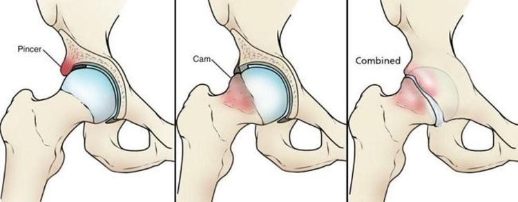 
Hình minh họa: 3 thể bệnh của Hội chứng chạm trong khớp háng (Impingement)
